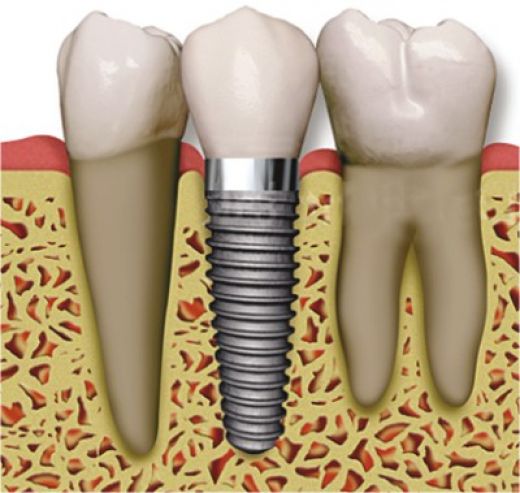 dental implant services Beverly hills