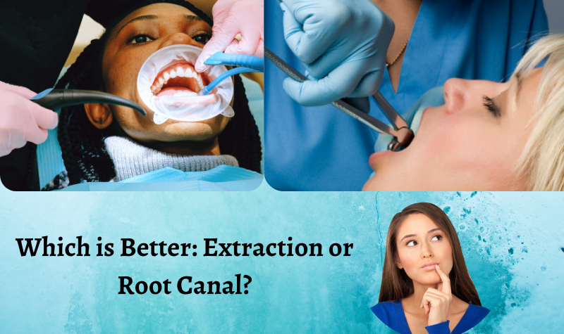 Which is Better: Tooth Extraction or Root Canal?