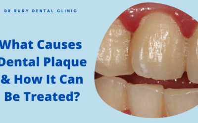 What Causes Dental Plaque and How It Can Be Treated?